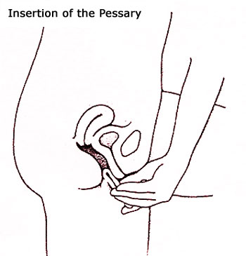 Insertion of the Pessary