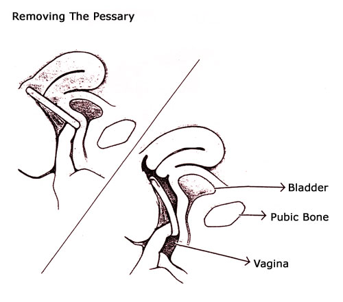 Removing the Pessary